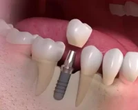 Impianti Dentali dalla A alla Z: Tutto Ciò che Devi Sapere