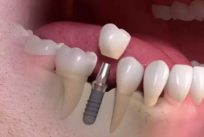 Impianti Dentali dalla A alla Z: Tutto Ciò che Devi Sapere