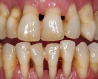 Un Sorriso Smagliante Anche con la Parodontite