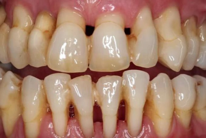 Un Sorriso Smagliante Anche con la Parodontite